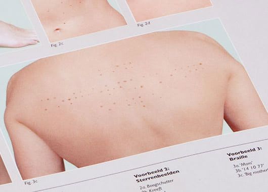 Visual of Birthmarks Tattoo