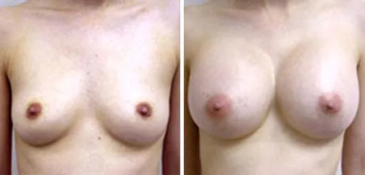 Fake for Real: Natural Breasts?