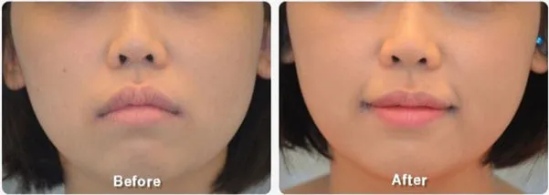 Feeling Sad? Ladies in Korea Go Under the Knife for a Perma-Smile