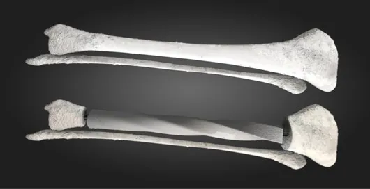 Swap Your Bones for an Improved, 3D-Printed Version