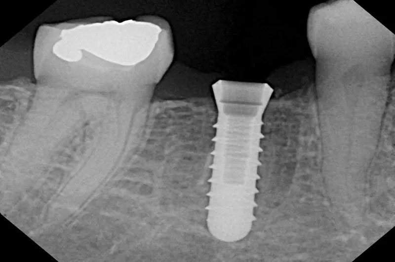 The Twitter Tooth Implant Becomes a Reality (Again)